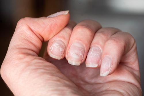 hand with brittle nails stock image